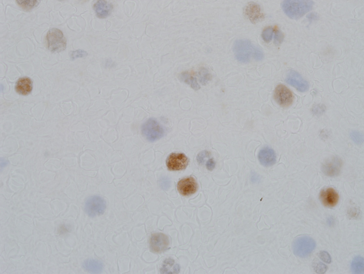 BM biopsy 2 clot TdT 100x
